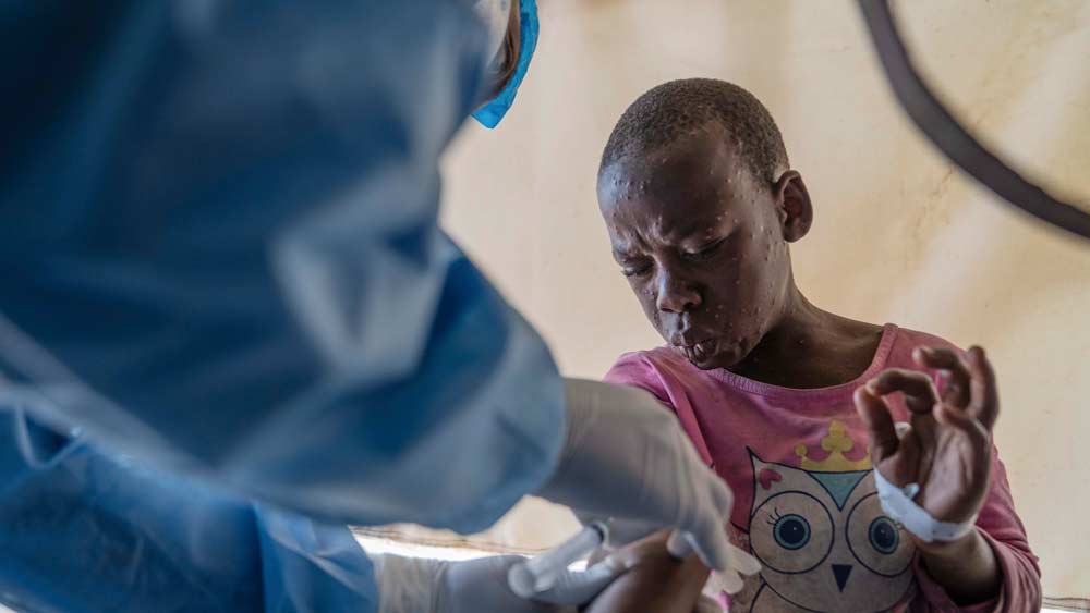 Congo Finally Begins Mpox Vaccinations in Drive to Slow Outbreaks Declared a Global Emergency